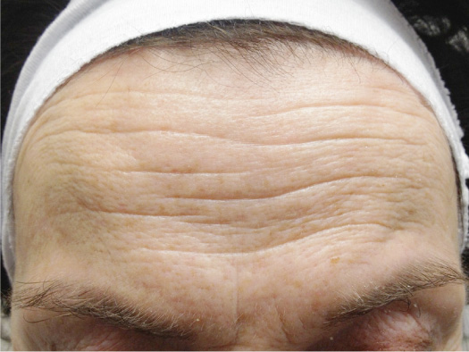 How To Remove Wrinkles From Forehead