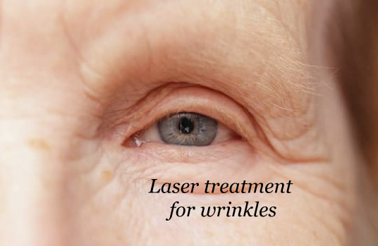 laser treatment for wrinkles