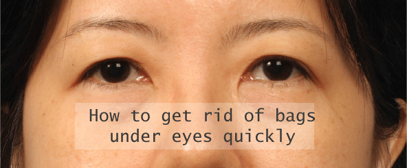 How to get rid of bags under eyes