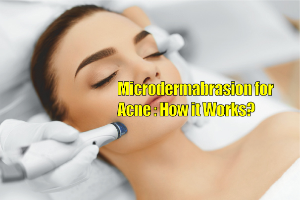 Microdermabrasion for acne