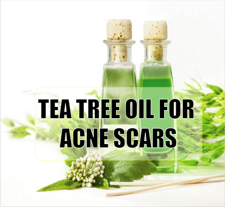 TEA TREE OIL FOR ACNE SCARS | Anti-Aging Young