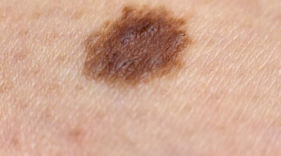 Skin discoloration on legs